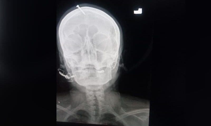 Рентген головы пострадавшей