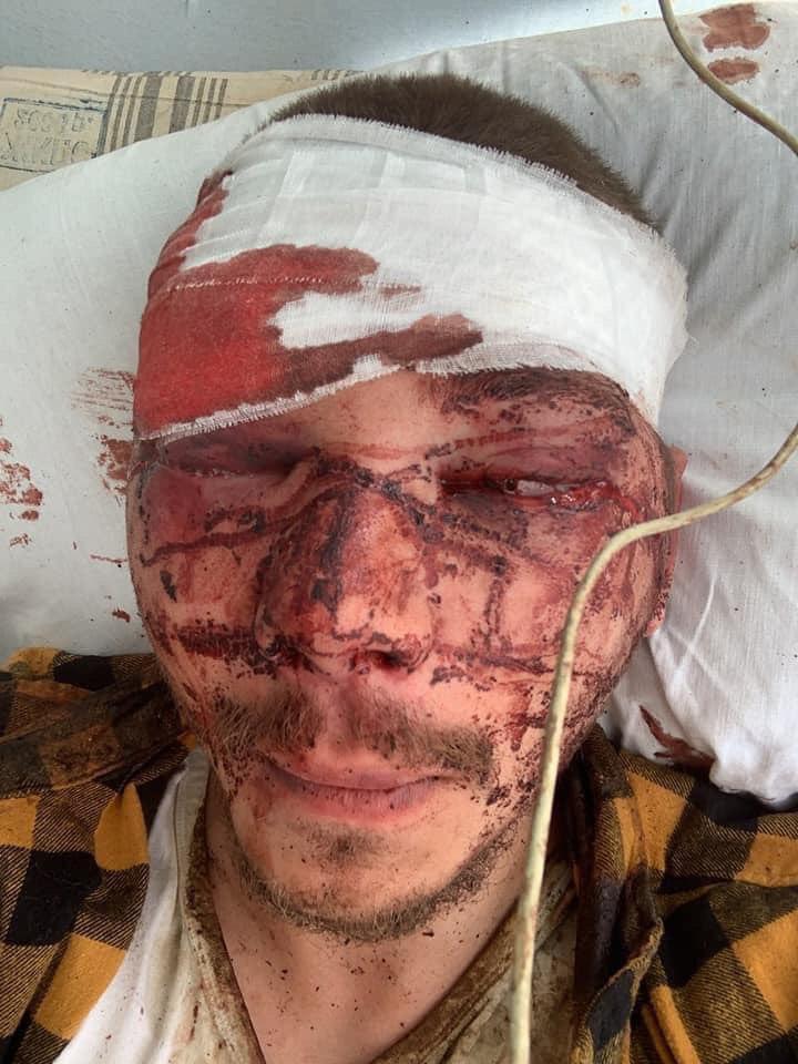 Никита Роженко после избиения. Фото: "Харьков Сейчас"